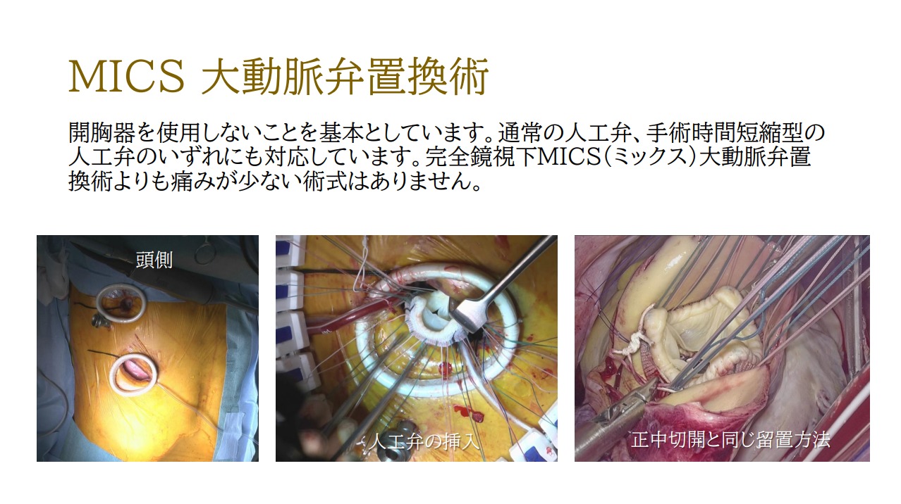 MICS 大動脈弁置換術
